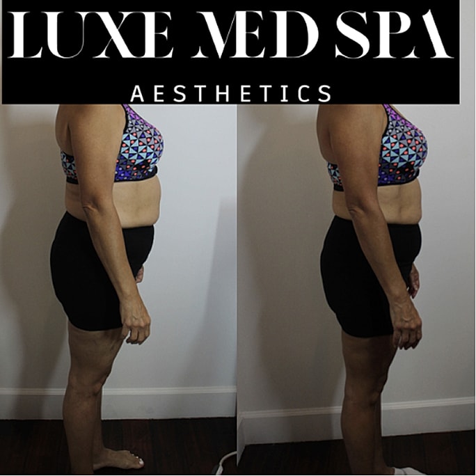 Before and after aesthetic treatment comparison photo.